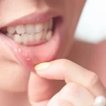 5 Tips Mencegah Sariawan Berulang di Mulut