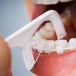 7 Tips Sikat Gigi Saat Behel agar Tetap Bersih Total