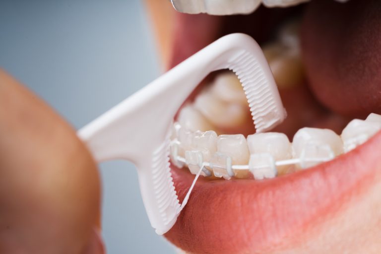 7 Tips Sikat Gigi Saat Behel agar Tetap Bersih Total