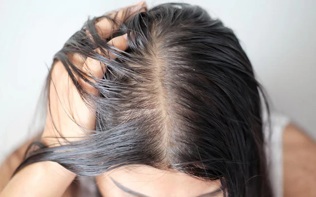 10 Tips Rambut Anti Lepek Buat Kamu yang Punya Kulit Kepala Berminyak