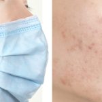 7 Cara Menghindari Jerawat Karena Penggunaan Masker (Maskne)