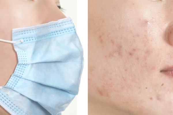7 Cara Menghindari Jerawat Karena Penggunaan Masker (Maskne)