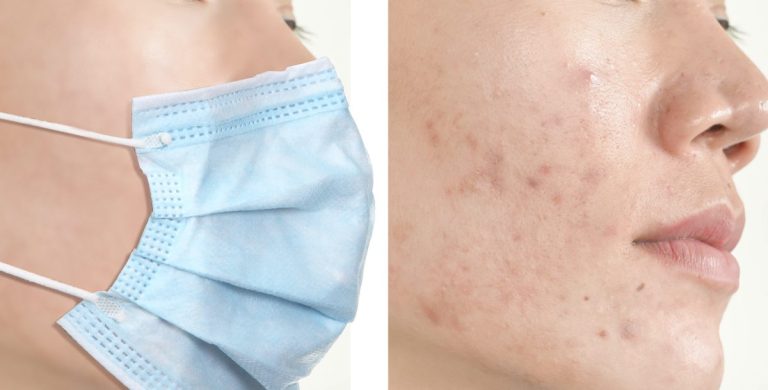 7 Cara Menghindari Jerawat Karena Penggunaan Masker (Maskne)